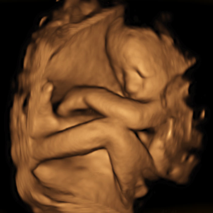 3D Ultrasound